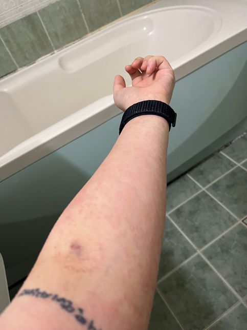 두드러기가 나서 출근을 못할거같은대 어떻게 말씀드려야 할까요ㅠㅠ의 1번 째 이미지