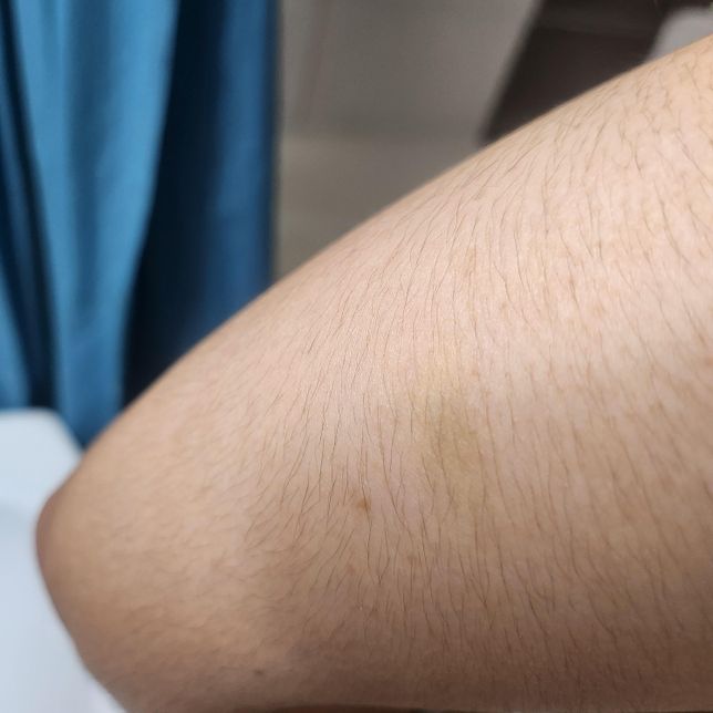 운동하고 팔이 노랗게 변했는데 멍든건가요?의 0번 째 이미지