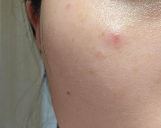 모기가있는데 물린자국은 없고 얼굴에 빨간 점이 생겼어요의 0번 째 이미지