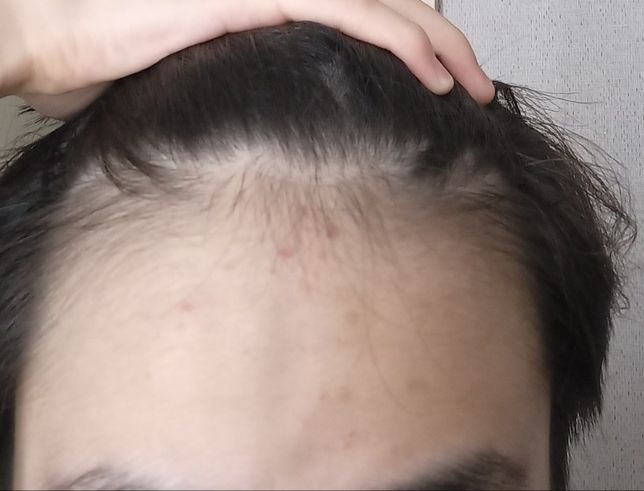 중학교2학년인데 혹시 이거 탈모증상인가요?의 0번 째 이미지