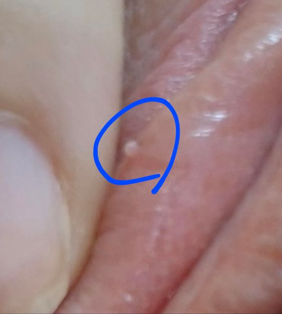 뾰루지 질문삭제 질문삭제 질문 삭제 +의 0번 째 이미지