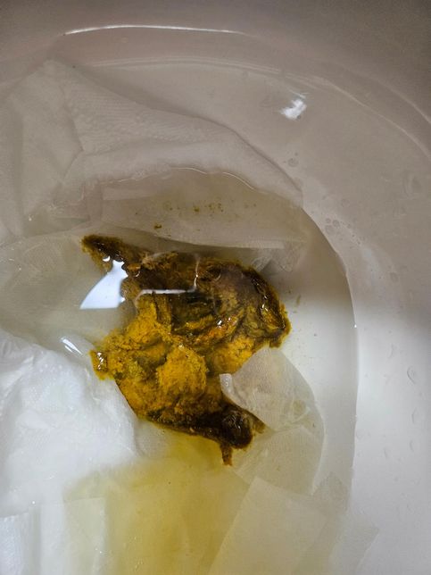 지방변인가요 무섭습니다 혈변인지ㅜ의 0번 째 이미지