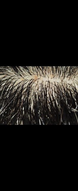 두피염 진균감염일경우 무조건 먹는진균제를 먹어야 낫나요?의 2번 째 이미지