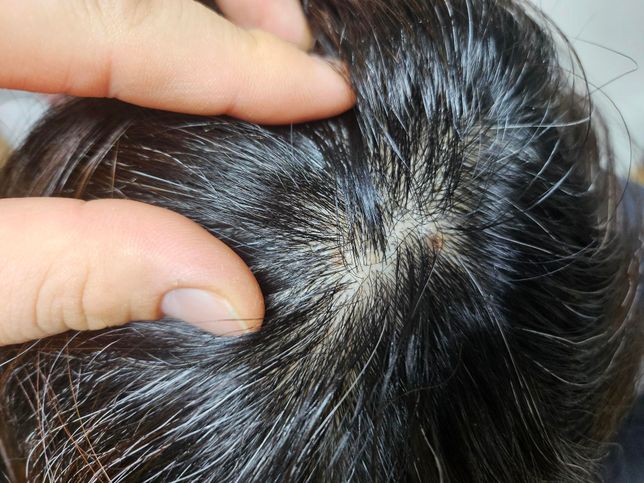 두피염 진균감염일경우 무조건 먹는진균제를 먹어야 낫나요?의 0번 째 이미지