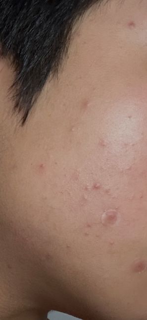 피부가 안좋아졌는데 어떻게해야할지모르겠어요(사진있음)의 0번 째 이미지