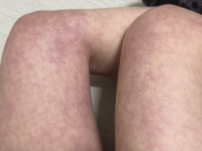 다이어트약 오남용으로 나타나는 증상 질병 유추하여 병원 알려주세요..의 2번 째 이미지