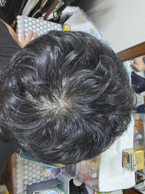 중학교 3학년 인데 정수리가 참... 도와주세요...의 1번 째 이미지