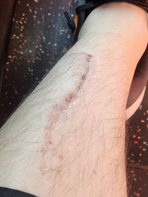 넘어져있는 안전펜스에 넘어져 2주진단의 0번 째 이미지