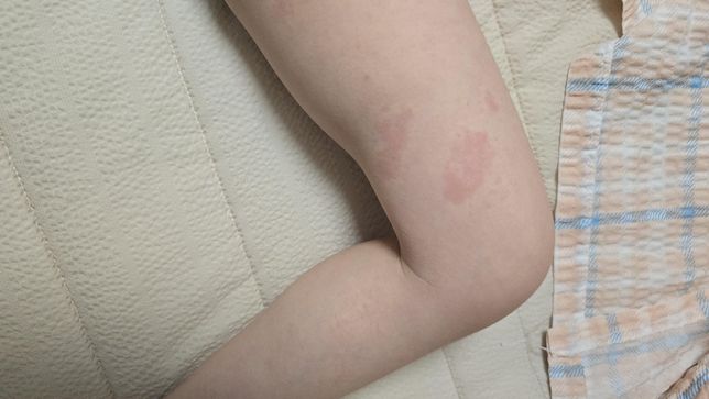 아이 셉트린정 피부발진 문의드립니다의 1번 째 이미지