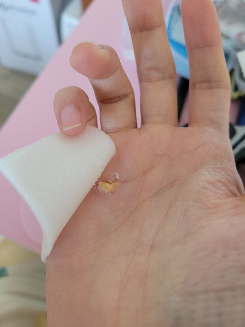 한의원 의료사고?2도화상 흉터에관한 배상책임의 1번 째 이미지