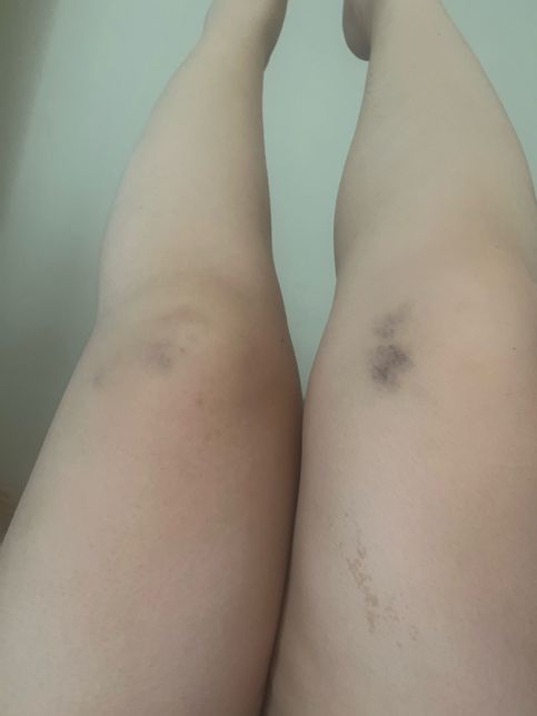 쿠팡물류센터 일용직 하루나가서 다쳣는데 산재될까요ᩚ?의 0번 째 이미지