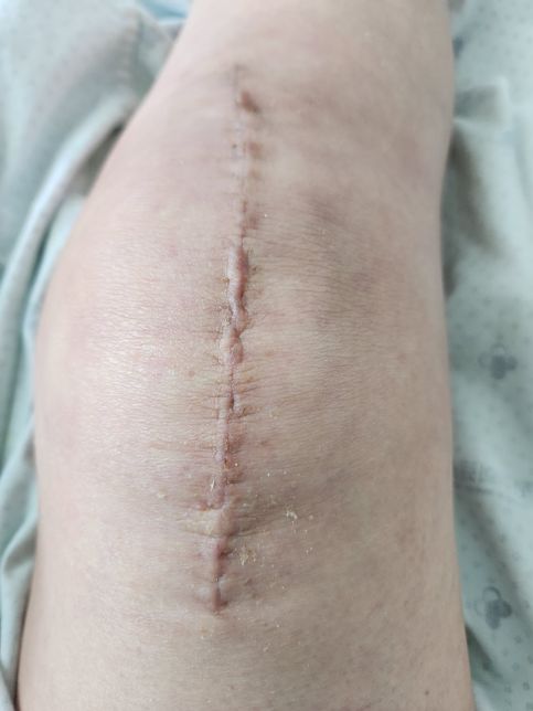 무릎 수술후 노스카나 바르면 원래 착색이 더 진해지나요?의 0번 째 이미지