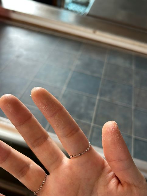 젤네일 알러지 때문잉가요 ˀ̣ 손가락 피부의 0번 째 이미지