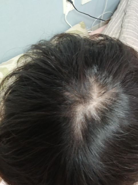 저 이거 탈모인지 가마인지 확인해주세요의 0번 째 이미지