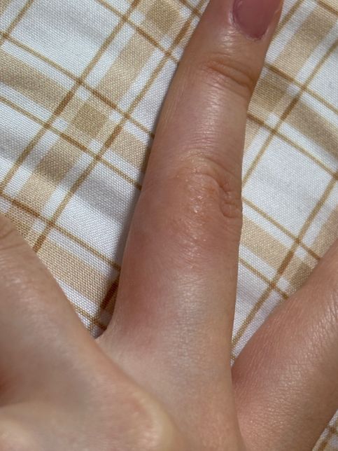 피부가 갑자기 왜 이러는건가요??? 알러지 일까여?의 1번 째 이미지