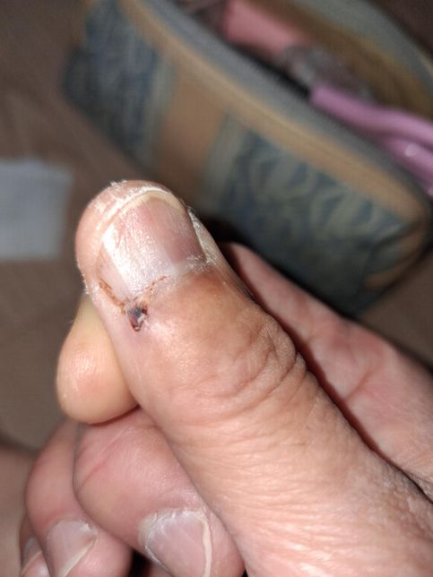 일주일지난 상처에는 무슨 연고를 발라야 하나요?의 0번 째 이미지