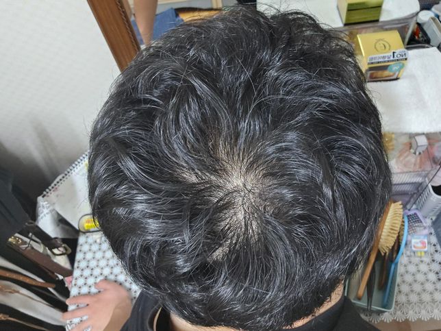 중학교 3학년 인데 정수리가 참... 도와주세요...의 3번 째 이미지