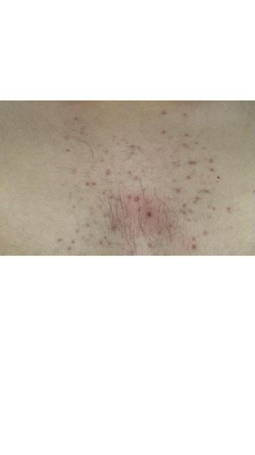 스테로이드제 복용후 가슴과 등에 빨간 여드름이 너무 많이나요....의 0번 째 이미지