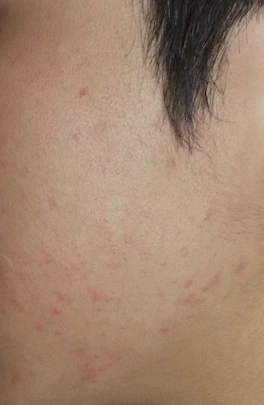 피부가 안좋아졌는데 어떻게해야할지모르겠어요(사진있음)의 2번 째 이미지
