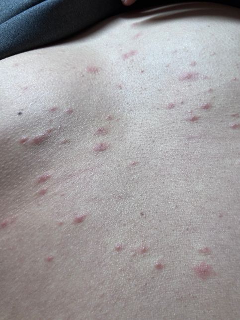 등과 가슴에 붉은 반점이 생겼습니다.의 2번 째 이미지