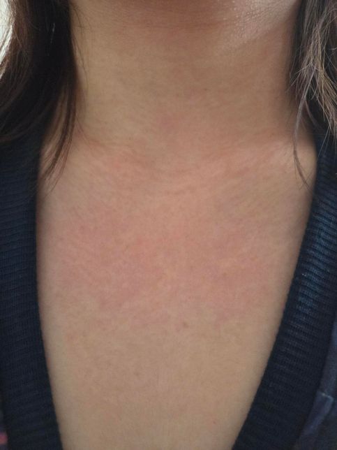 편도염약먹고 알레르기생긴거같은데요ㅠㅠ의 3번 째 이미지