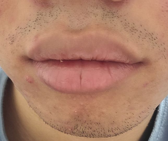 고1인데 수염자국이 너무 심합니다.의 1번 째 이미지