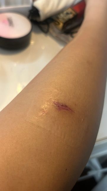 한달 된 상처 질문이요 (다리 상처 사진 있음)의 0번 째 이미지