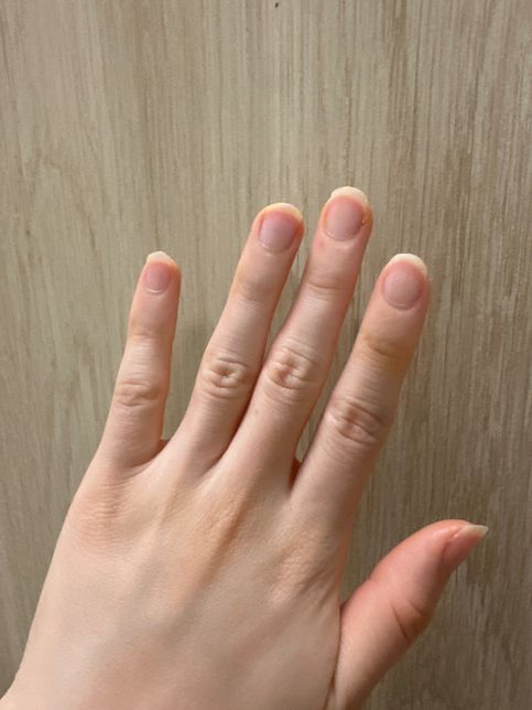 갑자기 손이 노란빛으로 변할 수 가 있나요?의 1번 째 이미지