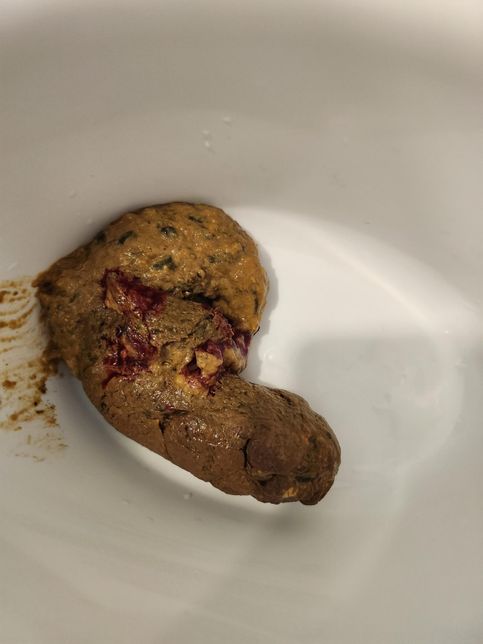 49개월 아이 변에 피가 섞여 나와요(사진주의)의 0번 째 이미지