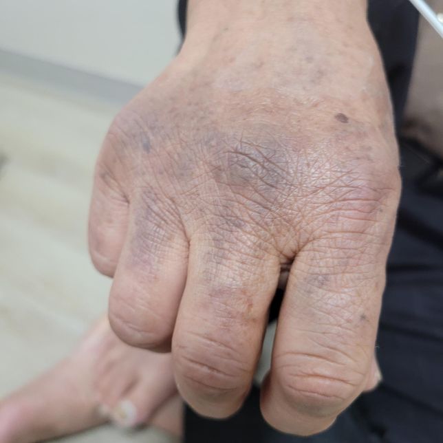 혈압약 부작용? 와파린 부작용? 아시는분 답변좀의 0번 째 이미지