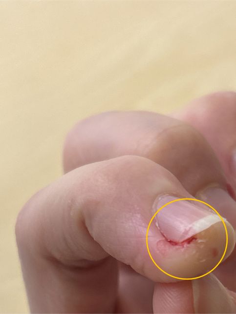 이거 혹시 손톱 무좀인가요? 아님 아토피습진인가요?의 0번 째 이미지