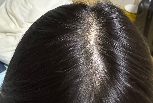 로잔정 복용 중인데 마이녹실 써도 되나요?의 0번 째 이미지