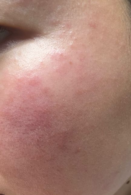 얼굴이 자잘자잘하게 부었는데 약영향일까요?의 2번 째 이미지