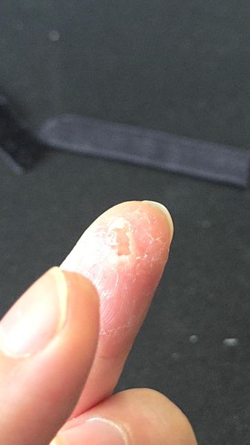 순간접착제가 손가락에 들이부어져서 살이 화상입은거같아용의 2번 째 이미지