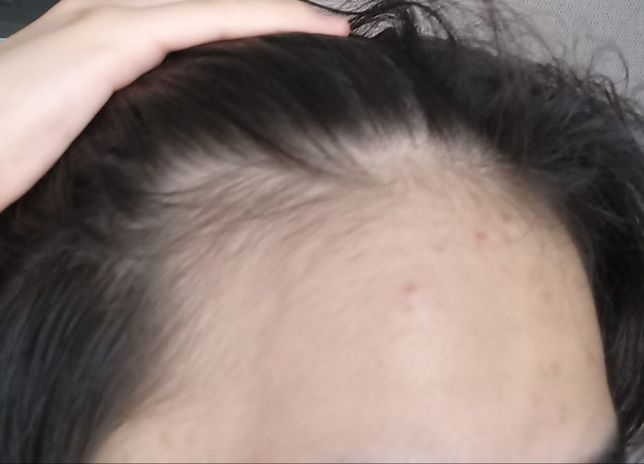 중학교2학년인데 혹시 이거 탈모증상인가요?의 1번 째 이미지