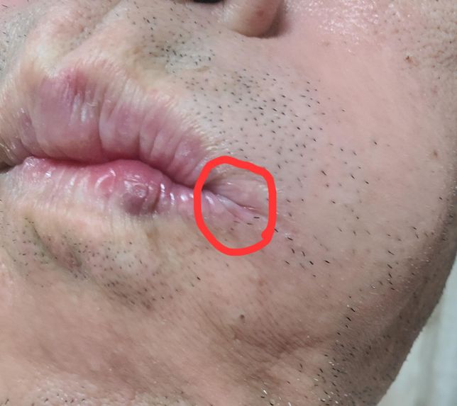 입가쪽 상처에 어떤 약 바르면 좋은가요?의 0번 째 이미지