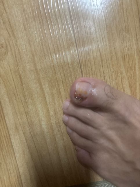갑상선항진증환자가 발가락상처 포비딘바르면 치명적??의 0번 째 이미지