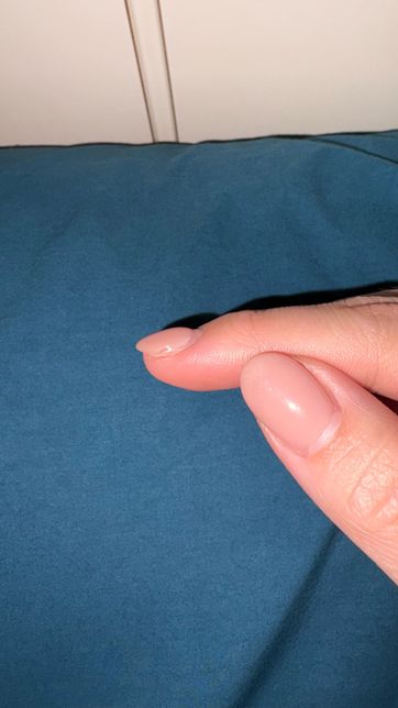 젤 네일 바른 검지손톱 측면에 검은부분 왜이러나요 곰팡이 인가요의 2번 째 이미지