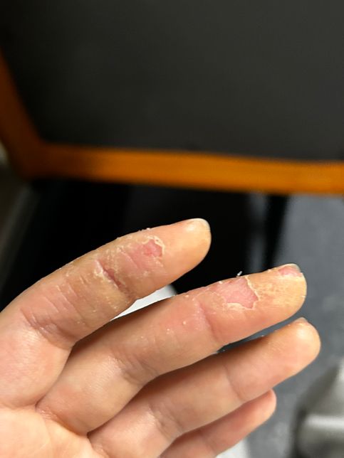 젤네일 알러지 때문잉가요 ˀ̣ 손가락 피부의 1번 째 이미지