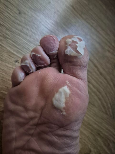 비오는데 일을계속했더이 발이 이렇게됐는데 괜찮을까요??의 0번 째 이미지
