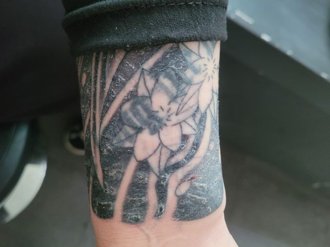 이레즈미를 했는데 하얀 각질때문에 질문드립니다 ㅠ의 0번 째 이미지