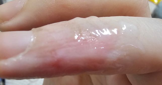 항생제연고바르고 거즈 필수일까요?의 0번 째 이미지