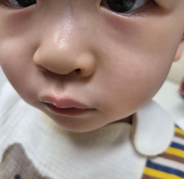 19개월 남자아기 검은 콧수염 이게 정상인가요?의 1번 째 이미지