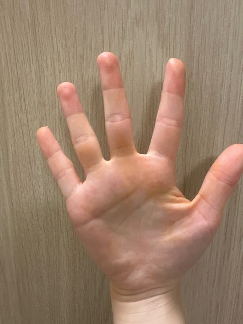 갑자기 손이 노란빛으로 변할 수 가 있나요?의 2번 째 이미지