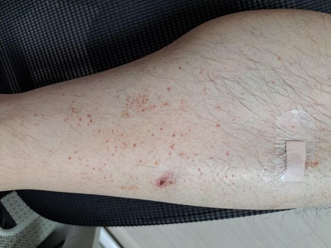 아래 피부발진은 약물부작용으로 인한 것인가요?의 0번 째 이미지