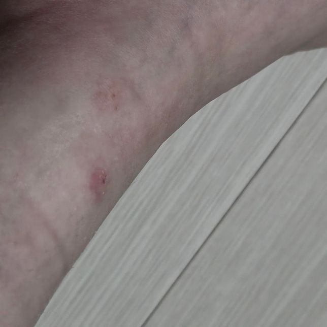 벌레 물린곳 좀 봐주세요(사진 첨부)의 0번 째 이미지