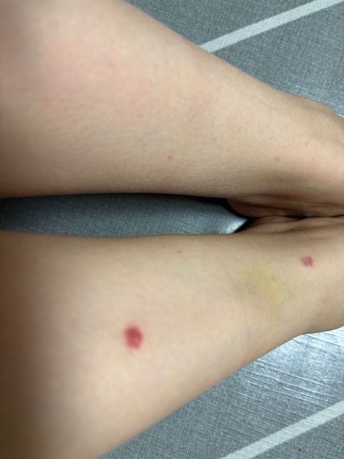 발등, 다리에 이렇게 뭐가 났어요..! 이게 뭘까요?의 1번 째 이미지