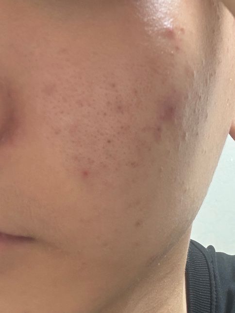 남자 청소년 피부 관리에 대하여 질문함의 0번 째 이미지