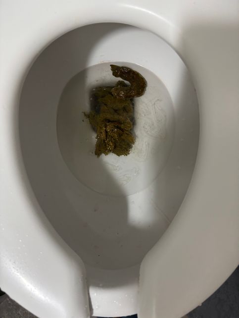 저변상태바주세요(치핵수술8일차의 0번 째 이미지