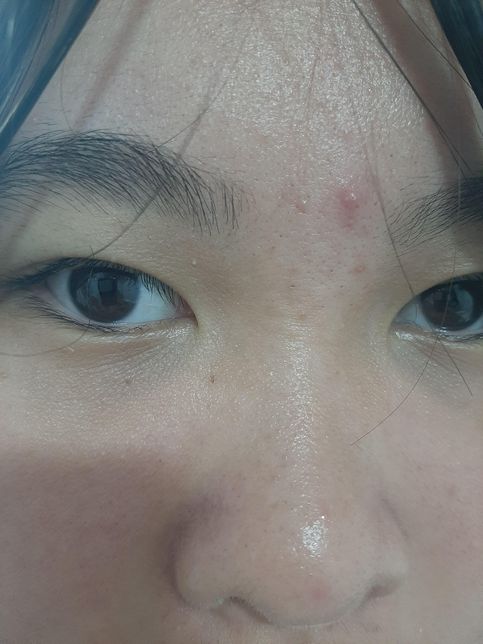 (사진첨부) 저 처진 세로 모공, 블랙헤드, 화이트헤드, 여드름 엄청 많은데... 이거 어떻게 해야하나요?의 1번 째 이미지